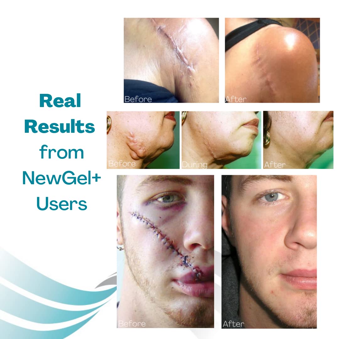 MyNewGel Advanced Silicone Scar Sheets – 1 x 6 inch, 4 Count, CLEAR