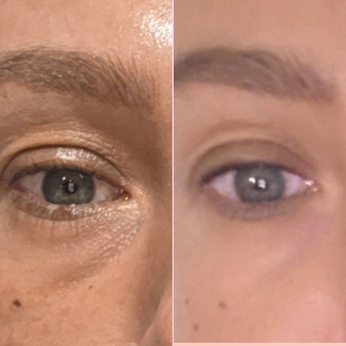 Dark Circles Under Eye Oil