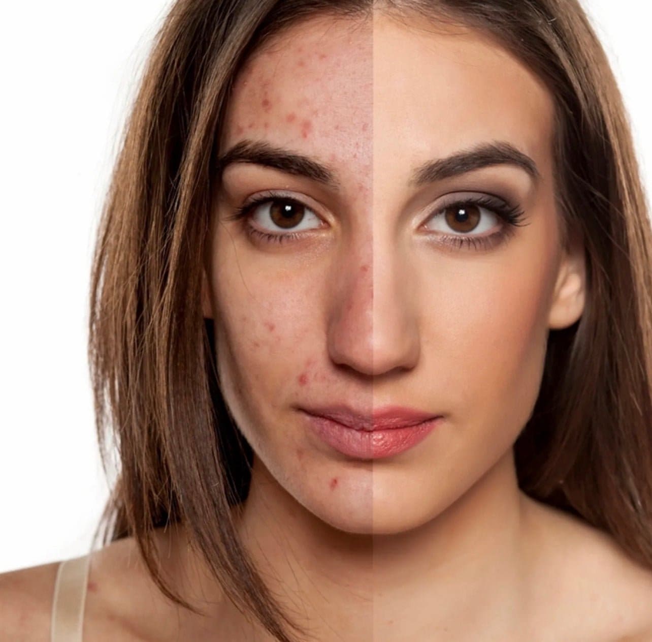 Acne Control Set