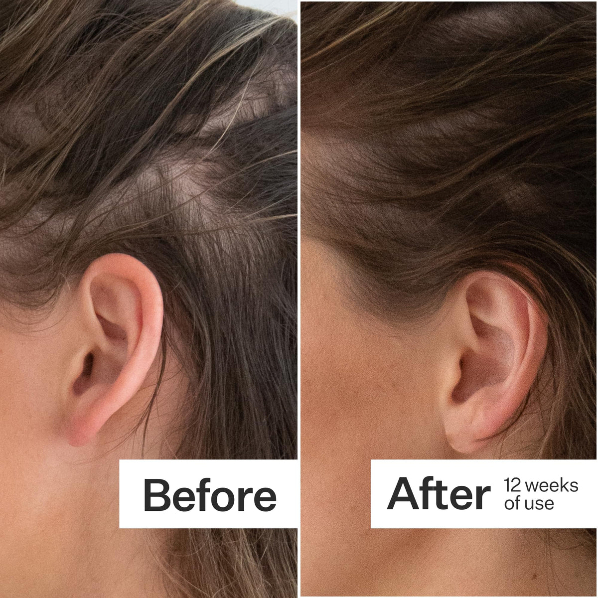 ACT+ ACRE Thick + Full Hair Capsules - Vegan Hair Support, 60ct