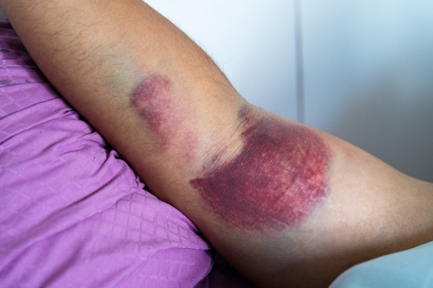Arnica Cream for Bruises & Scars – Handmade Herbal Ointment