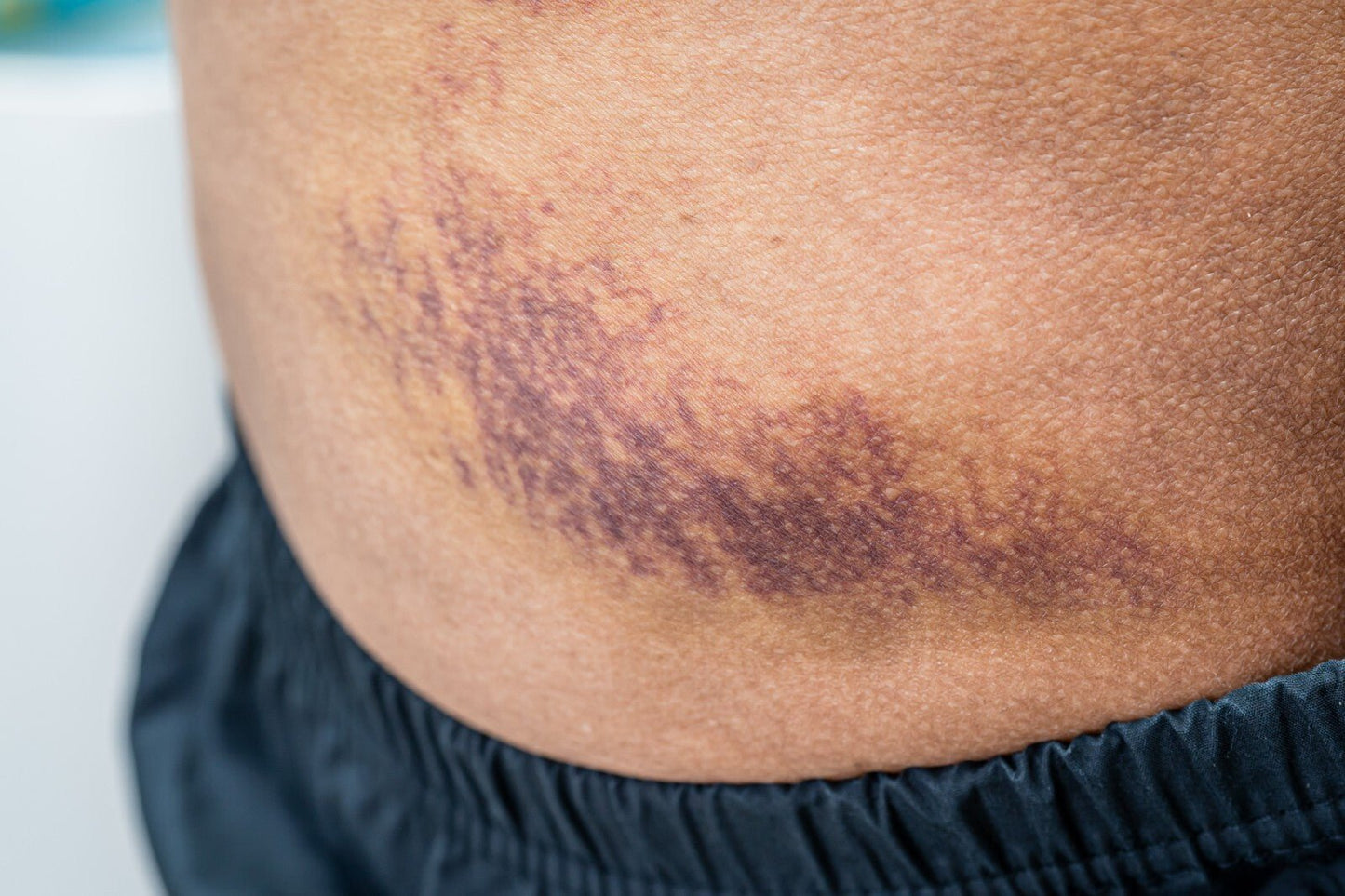Arnica Cream for Bruises & Scars – Handmade Herbal Ointment
