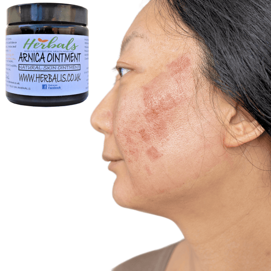 Arnica Cream for Bruises & Scars – Handmade Herbal Ointment