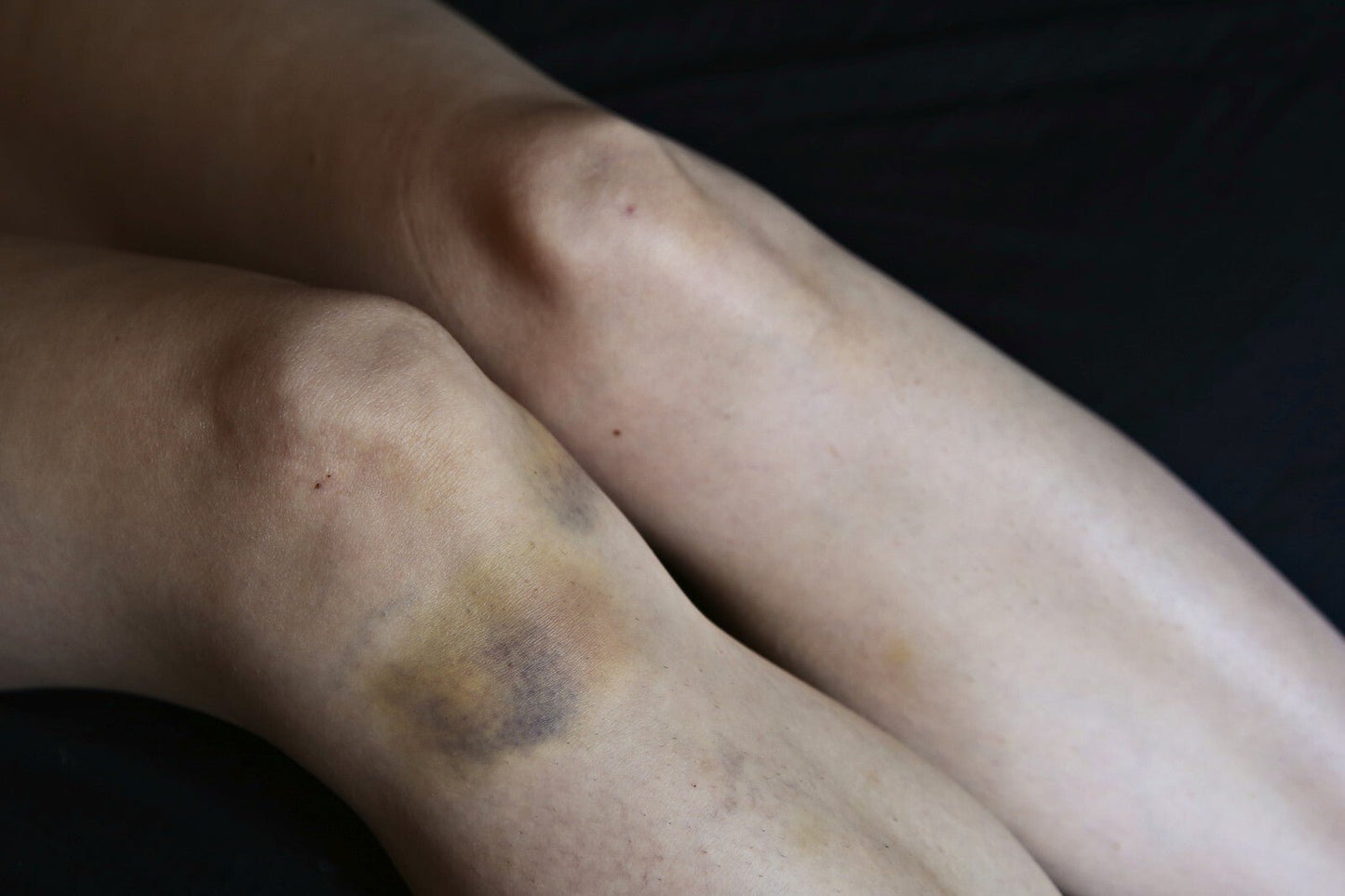 Arnica Cream for Bruises & Scars – Handmade Herbal Ointment
