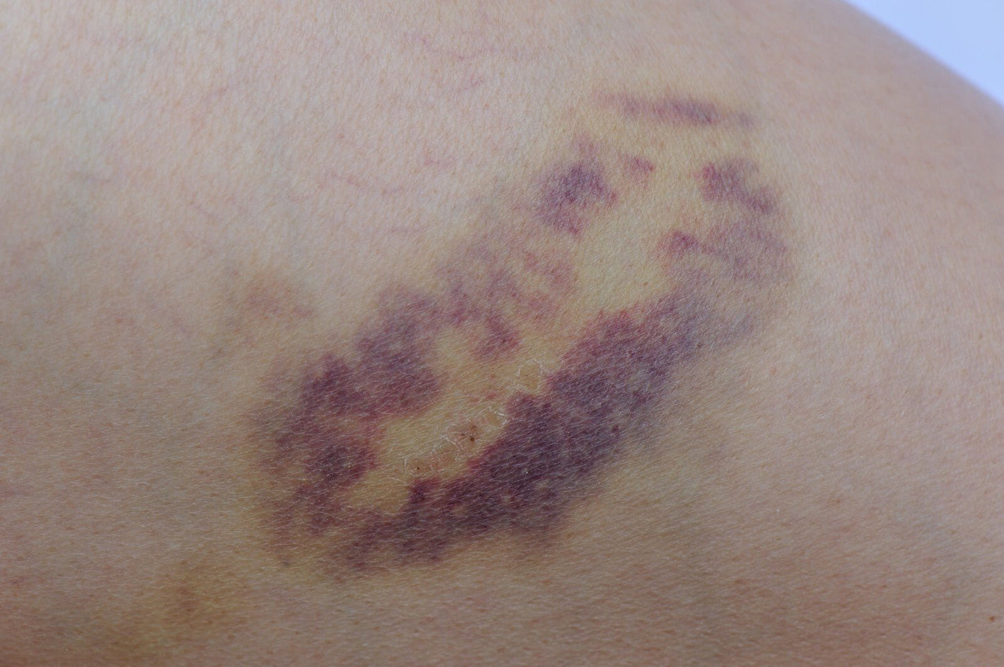 Arnica Massage Oil – Natural Herbal Remedy for Bruises Swelling & Aches Handmade