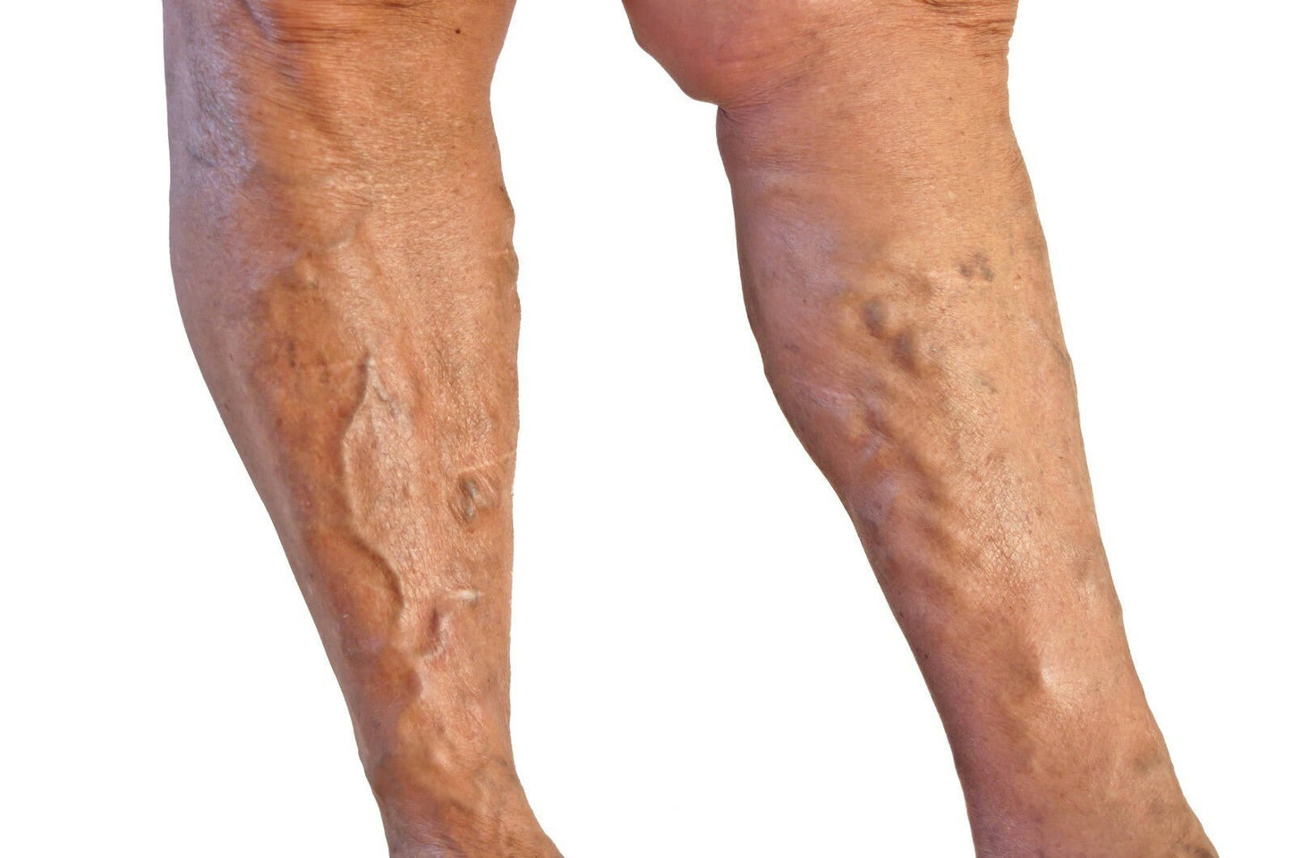 Calendula Oil Varicose Veins 50ml Natural Soothing Eczema Swelling Bruising Oil