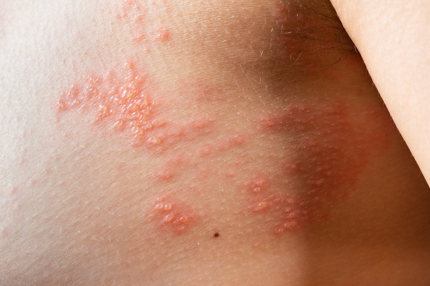 Herbalshire Scalp Psoriasis Shampoo - Natural Herbal Relief for Inflamed Scalp