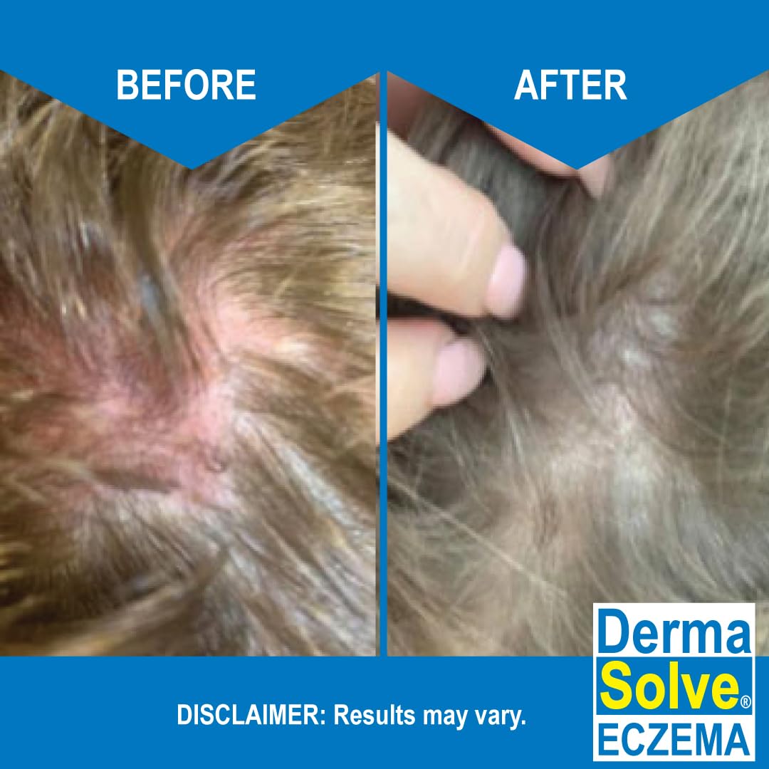 Dermasolve Eczema Shampoo & Conditioner Combo Pack – Steroid-Free for Kids & Adults