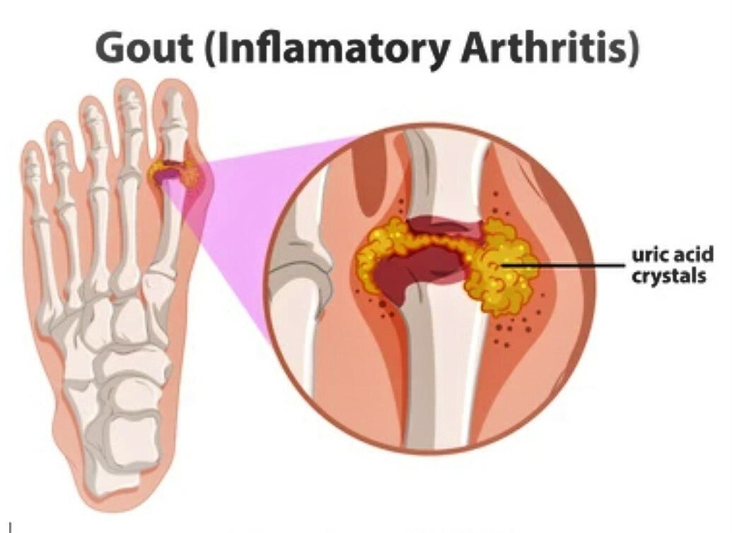 Gout Relief Cream Natural Herbal Balm – Arthritis Pain Ointment UK Handmade