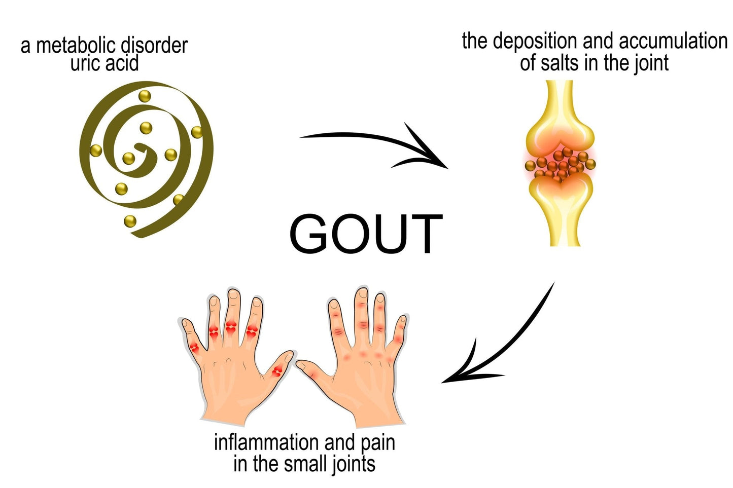 Gout Treatment Herbal Cream - Natural Pain Relief for Gout Arthritis - Handmade