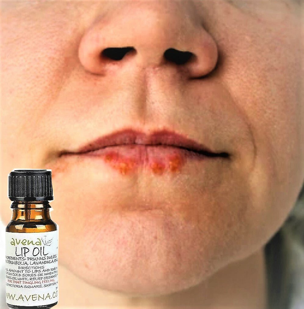 Herbal Lip Oil Lotion Natural Cold Sore Relief - Prevents and Soothes Cold Sores