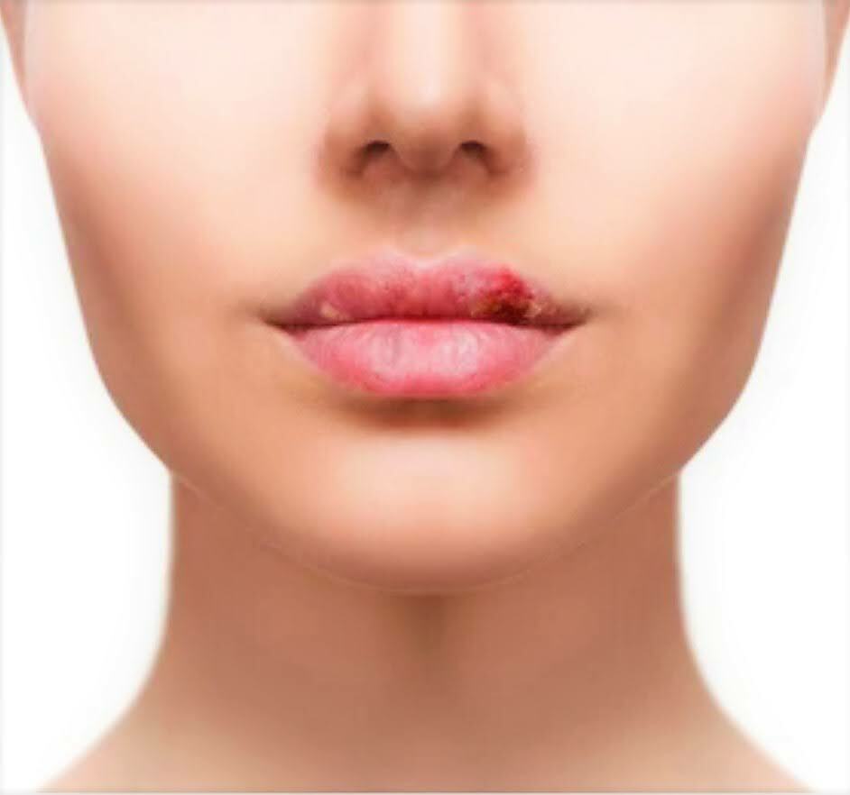 Cold Sore Relief Oil – Natural Lip Treatment with Tea Tree, Lavender & Vitamin E – Handmade in Yorkshire by Herbalshire