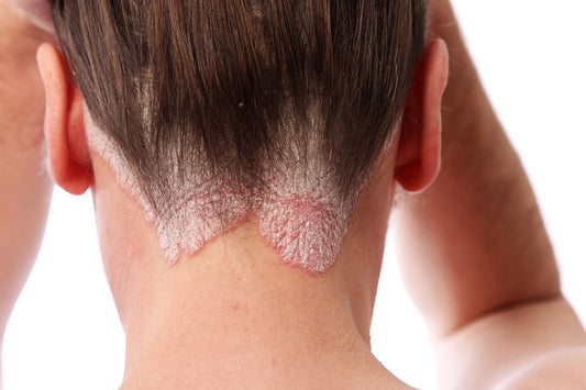 Herbalshire Scalp Psoriasis Shampoo - Natural Herbal Relief for Inflamed Scalp