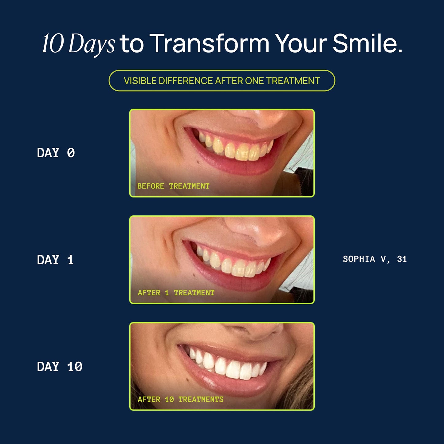 Laughland Everyday to Go Whitening Teeth Pen – 8% Hydrogen Peroxide, Gentle on Sensitive Teeth, 6 Treatments