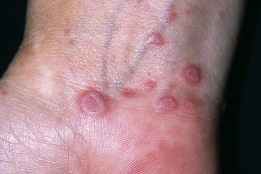 Lichen Planus Relief Oil 100ml – Natural Herbal Rash & Itchy Skin Treatment