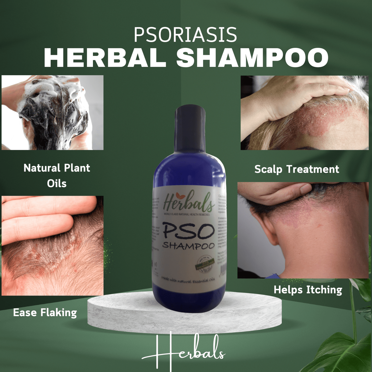 Natural Psoriasis Shampoo – Handmade Relief for Dry, Flaky, Itchy Scalp – 250ml