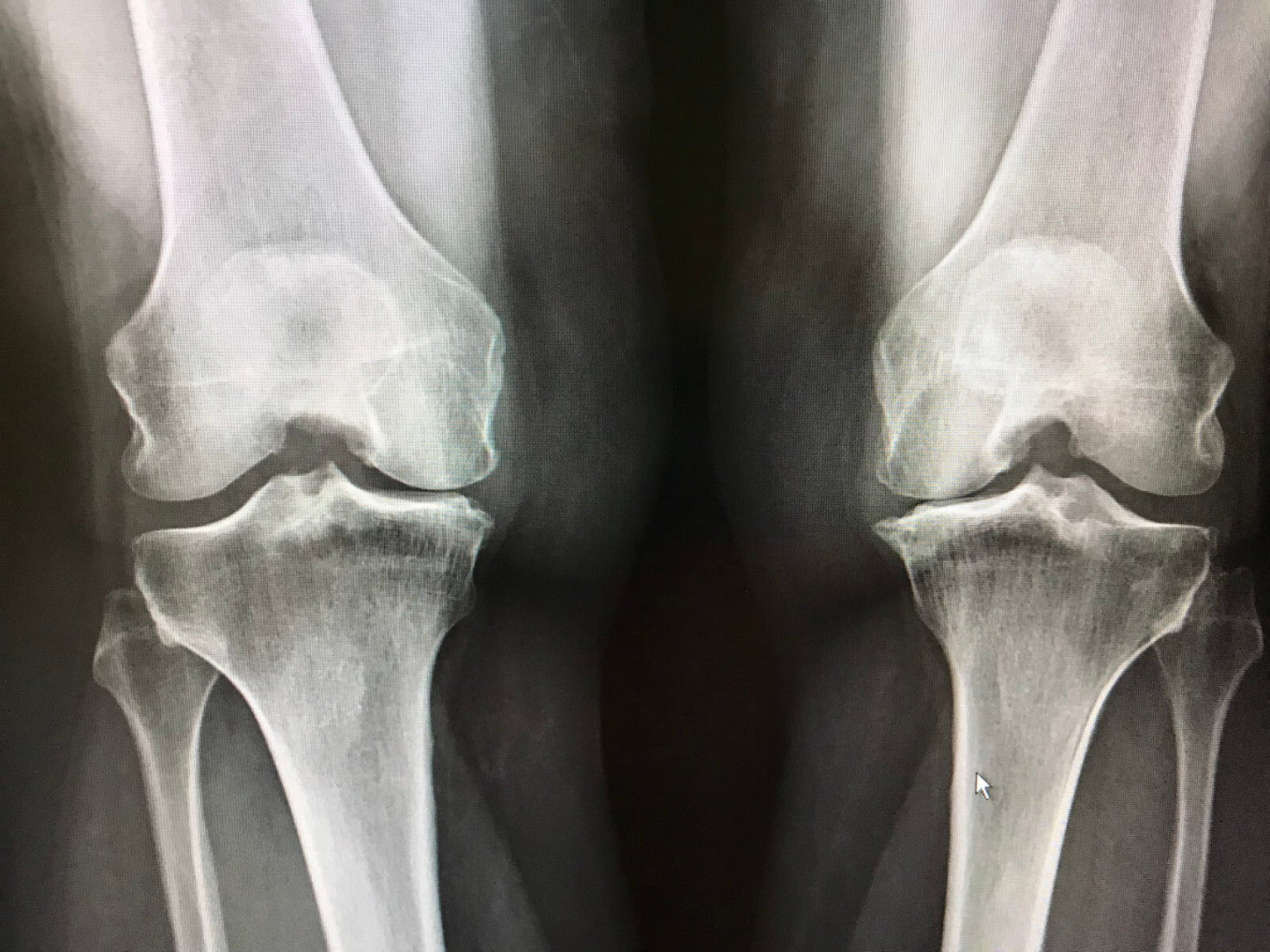 Osteoarthritis Knee Joint Pain Relief Oil – Natural O.S.T. Massage Blend
