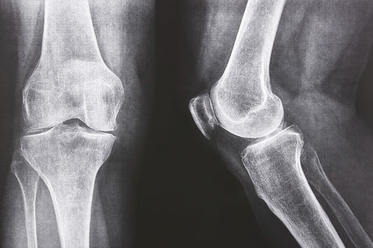 Osteoarthritis Pain Relief Cream | Natural Joint Balm for Knee, Hip, Spine & Hands | UK Handmade