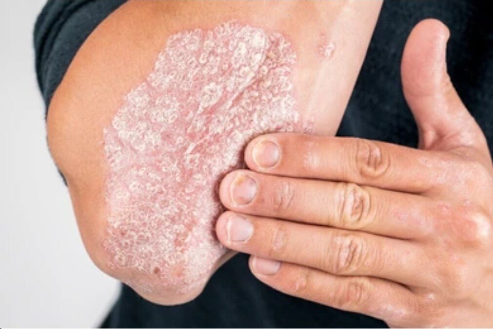 Psoriasis Cream From Abluo 60ml Beauty Body Product Eczema Skin Problem Healing