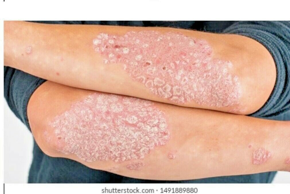 Psoriasis Cream From Abluo 60ml Beauty Body Product Eczema Skin Problem Healing
