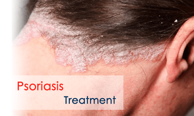 PSO Herbal Scalp Care Shampoo - Effective Dandruff Treatment & Soothing Psoriasis Relief