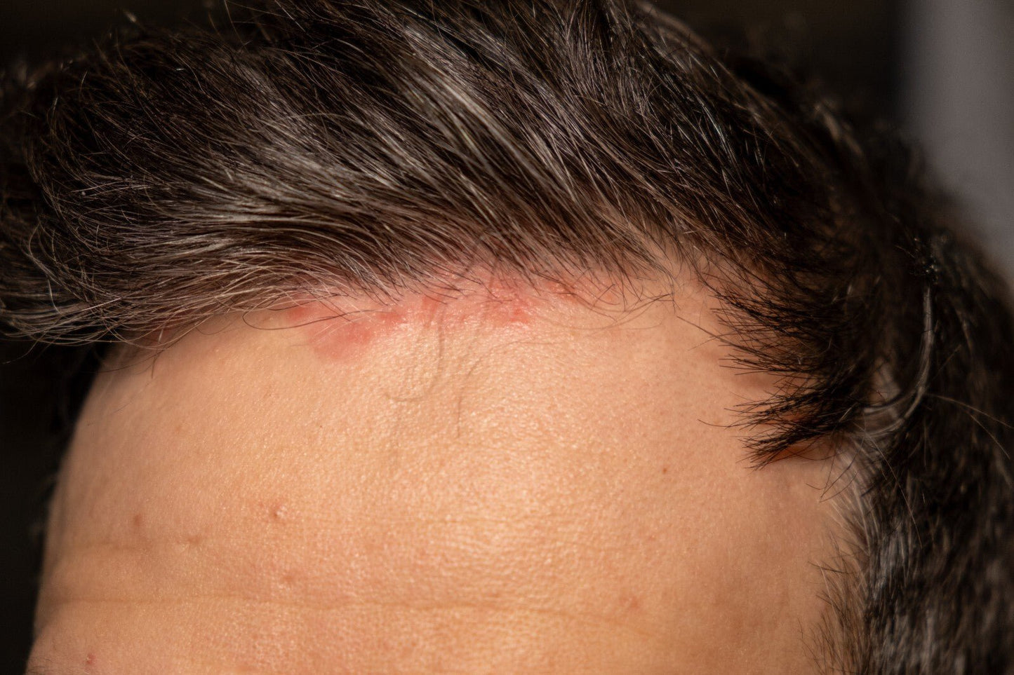 Scalp Psoriasis Treatment Shampoo Natural Handmade Relief for Flaky Itchy Scalp
