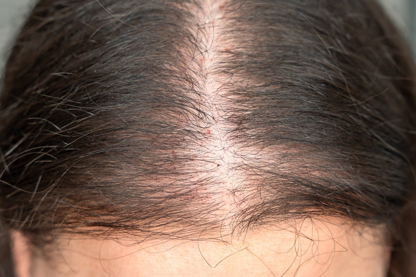 Scalp Psoriasis Treatment Shampoo Natural Handmade Relief for Flaky Itchy Scalp