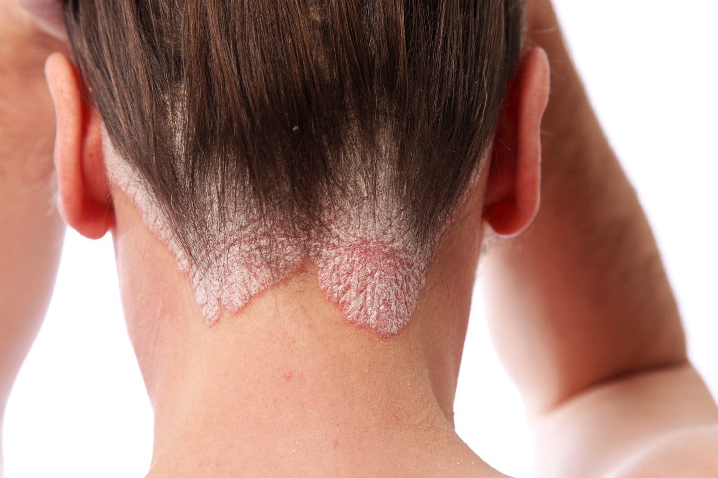 Scalp Psoriasis Treatment Shampoo Natural Handmade Relief for Flaky Itchy Scalp