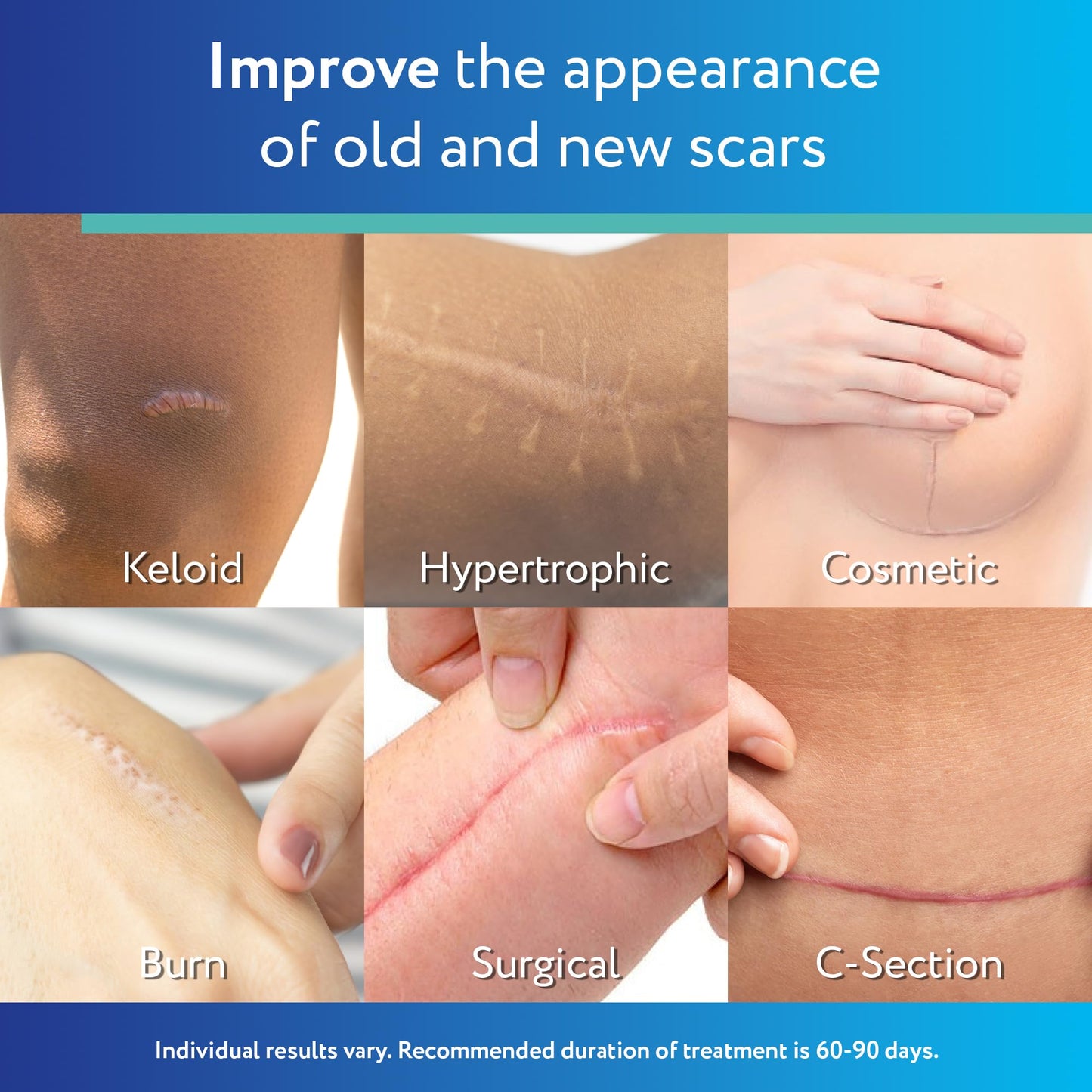 ScarAway Advanced Clear Silicone Scar Sheets (1.5 x 3 in) – 6 Medical-Grade Sheets
