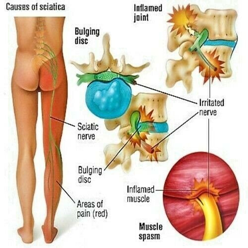 Sciatica Cream – Nerve Pain Relief Balm – Herbal Back & Leg Pain Treatment UK