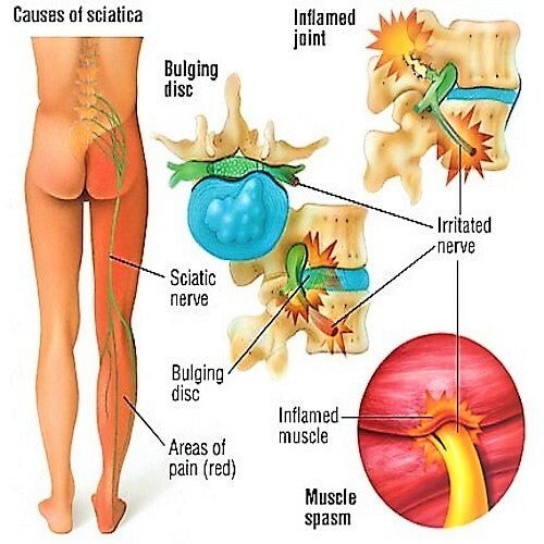 Sciatica & Nerve Pain Relief Oil – Herbal Massage Oil for Nerves Muscles & Joints – Handmade in Yorkshire