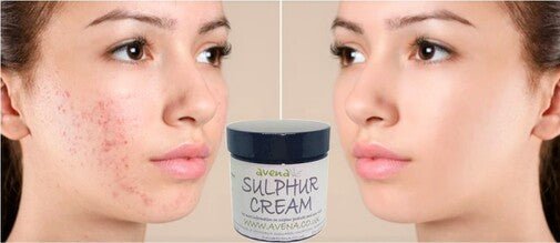 Sulphur Cream 35g – Gentle Herbal Formula for Clear, Healthy Skin