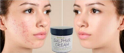 Sulphur Cream for Acne Eczema Rosacea – Natural Spot Treatment – Made in UK