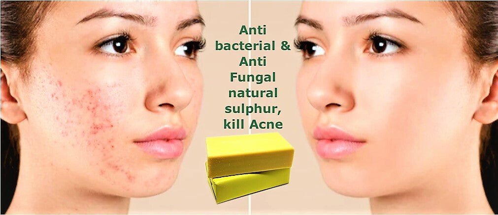 Sulphur Soap Bar 200g – Natural Acne, Rosacea, Eczema & Fungal Treatment UK