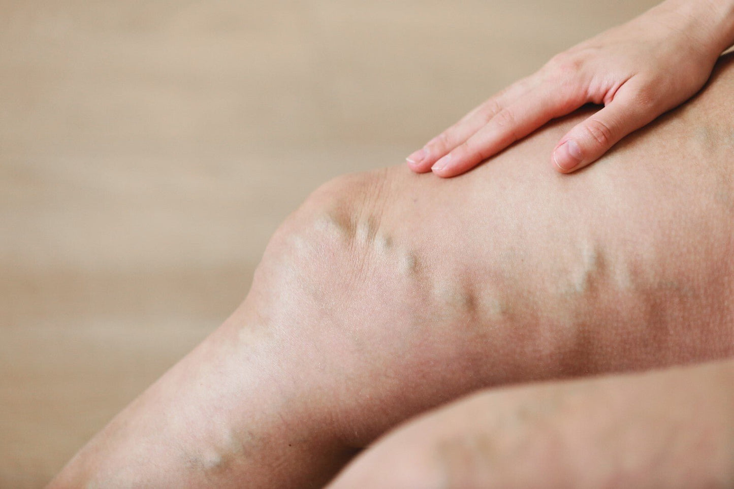 VV Calendula Balm - Natural Treatment for Visible Veins and Skin Conditions