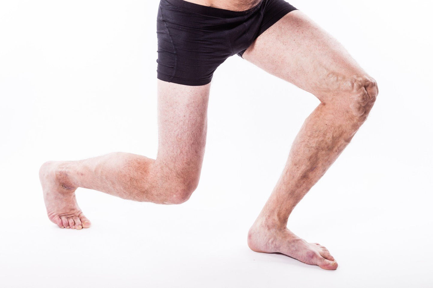 VV Calendula Balm - Natural Treatment for Visible Veins and Skin Conditions