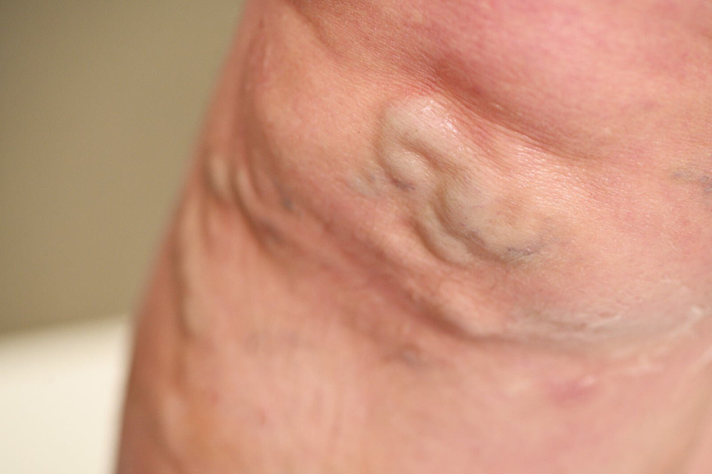VV Calendula Balm - Natural Treatment for Visible Veins and Skin Conditions