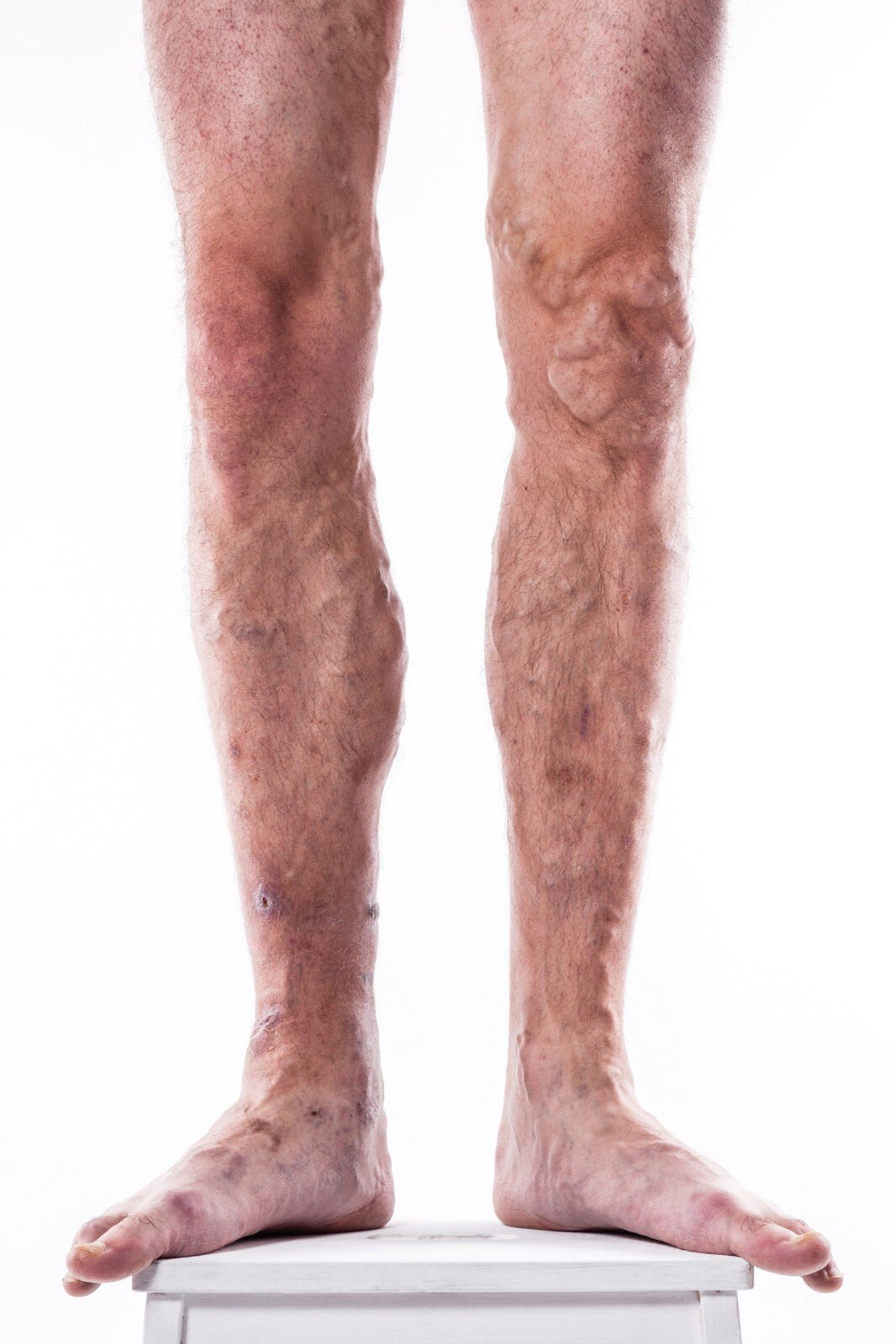 VV Calendula Balm - Natural Treatment for Visible Veins and Skin Conditions